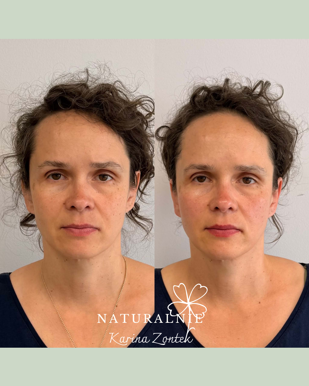 Zabieg Neurolifting