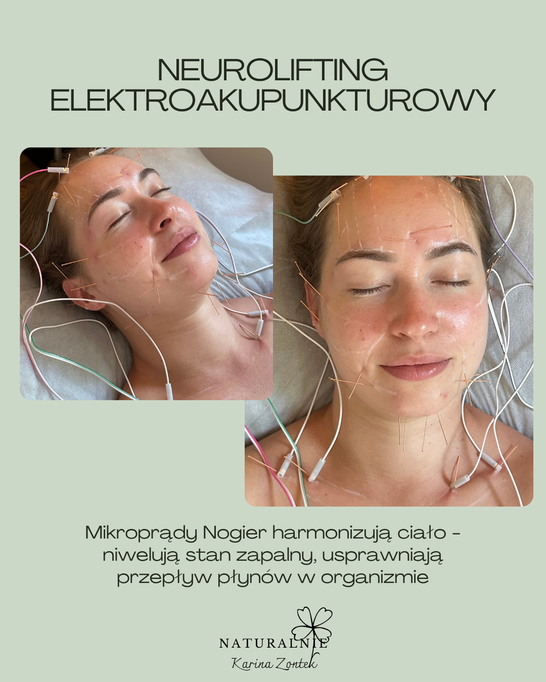 Zabieg Neurolifting