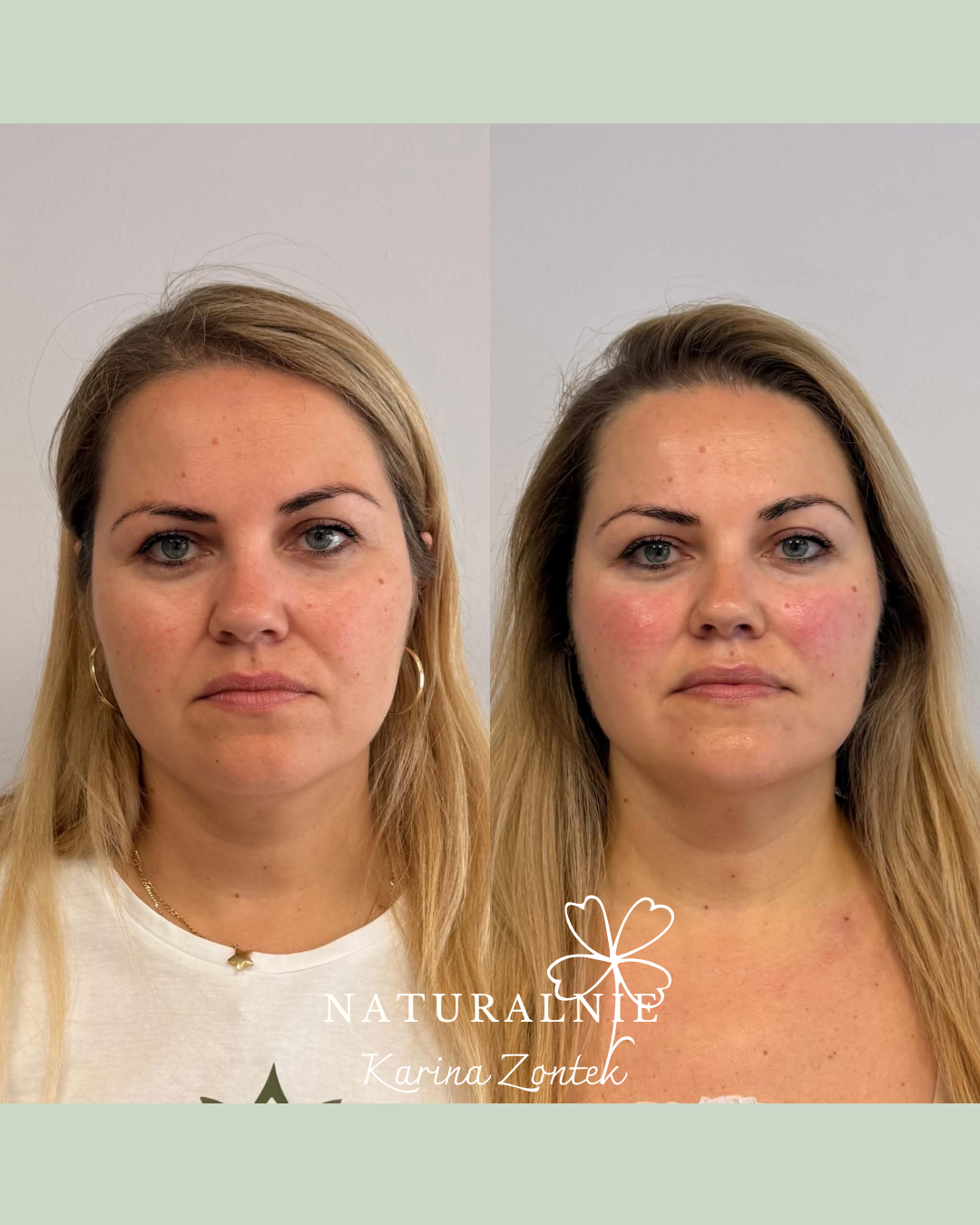 Zabieg Neurolifting